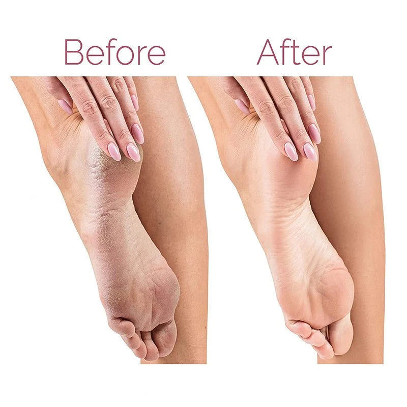 Electric Pedicure Foot File Callus Remover | Rechargeable Waterproof Foot Care Device for Smooth Soft Heels